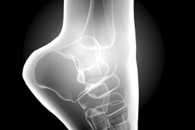 Masteling Fysiotherapie Amsterdam sportblessure hardlopen begeleiding analyse behandeling